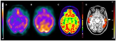 Clinical Usefulness of SISCOM-SPM Compared to Visual Analysis to Locate the Epileptogenic Zone